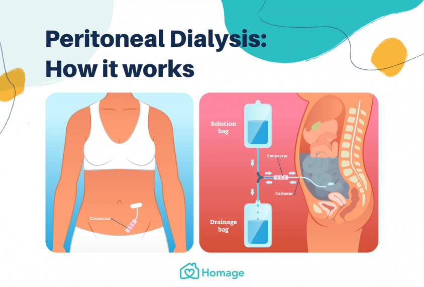 A Complete Guide To Peritoneal Dialysis In Malaysia Homage Malaysia